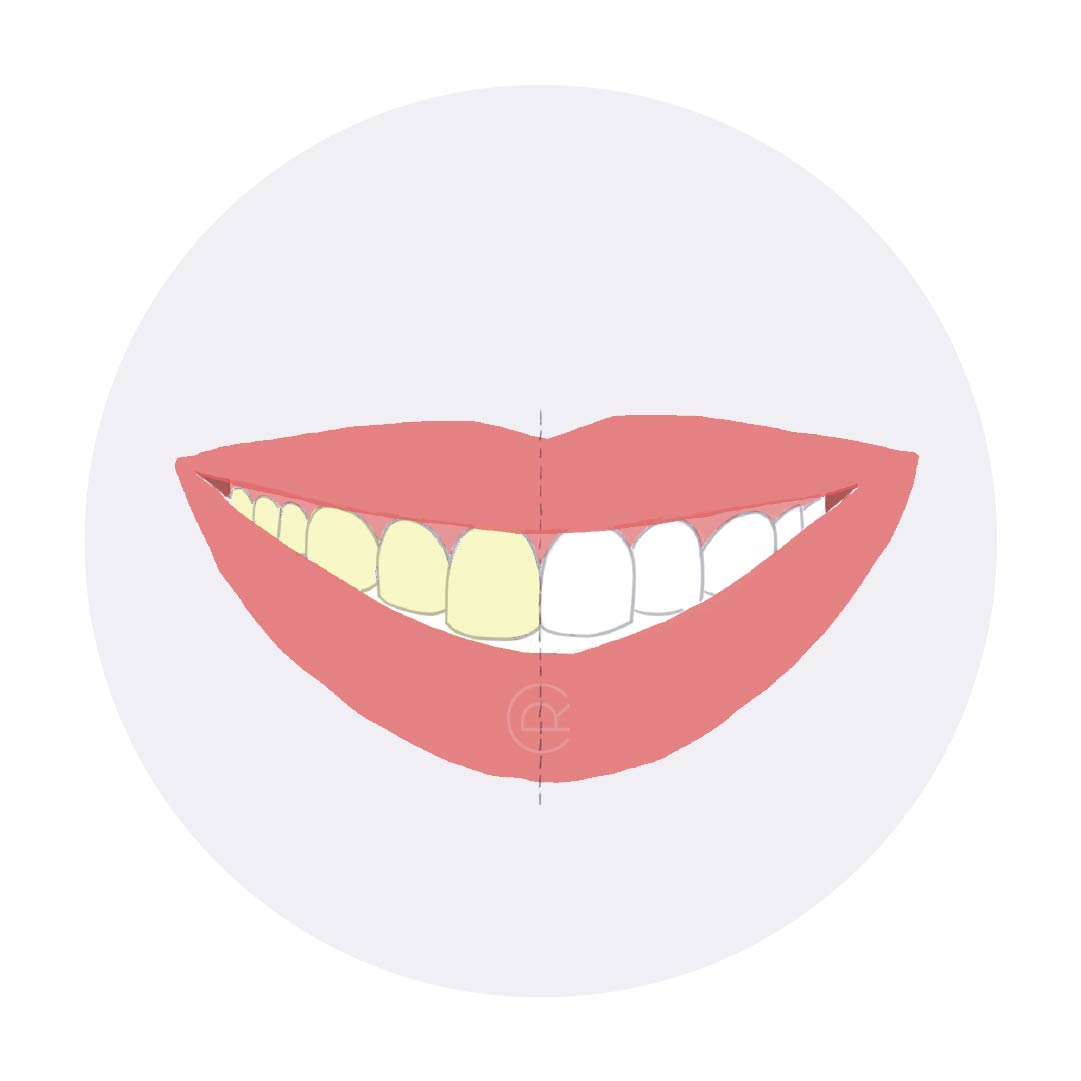 Blanqueamientos dentales en consultorio